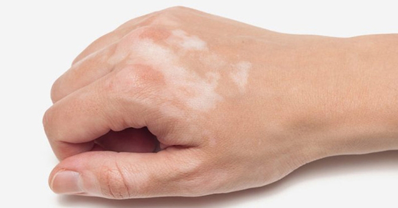 Biểu hiện của bệnh lang ben là gì