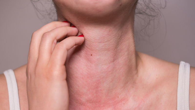 Nếu bị dị ứng với tôm, nên tránh ăn loại thực phẩm này nếu không muốn nổi mẩn đỏ, ngứa khó chịu