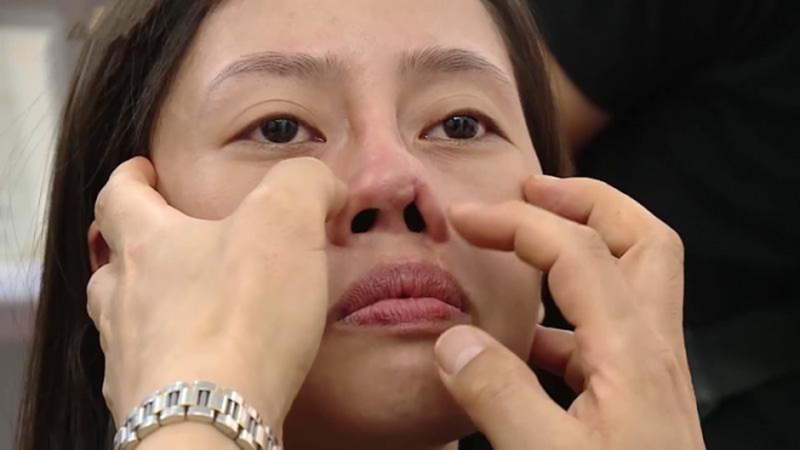 Giải đáp thắc mắc: Nâng mũi bị bao xơ là gì? 1