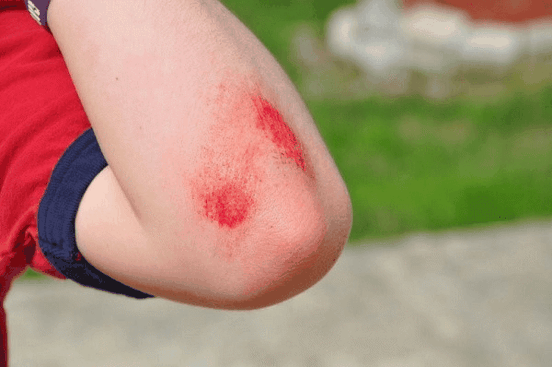 Một số lưu ý cần biết khi chăm sóc vết thương hở tại nhà 1