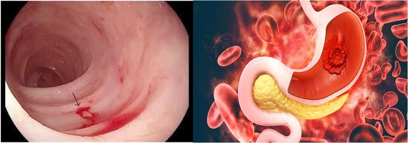 10 biến chứng xơ gan nguy hiểm nhất không nên bỏ qua1