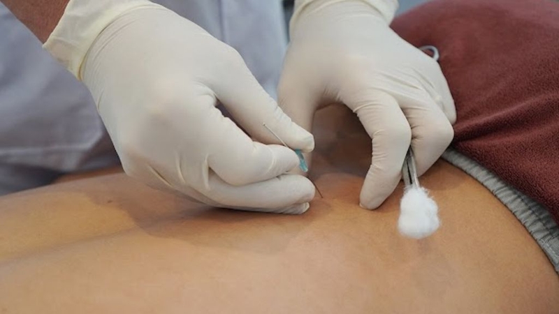 10 Triệu chứng sau khi cấy chỉ mà bạn nên biết 4