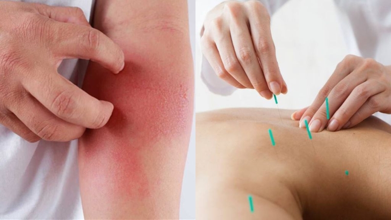 10 Triệu chứng sau khi cấy chỉ mà bạn nên biết 1