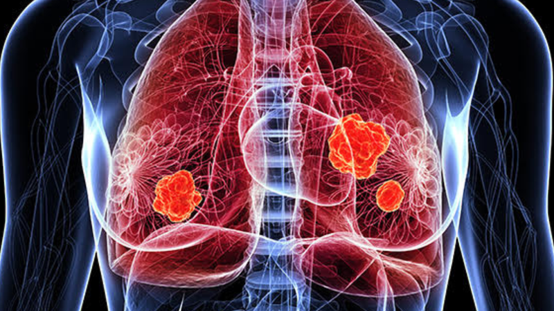 Cơn đau này có thể xuất phát từ việc khối u xâm lấn vào thành ngực