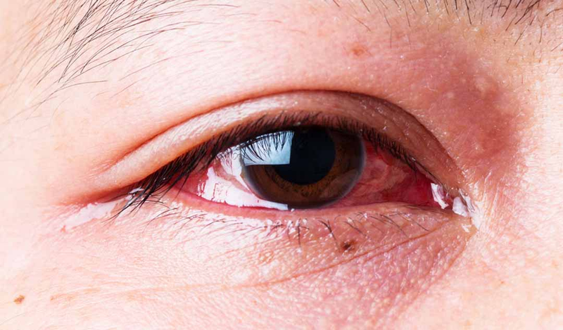 12 lý do bạn có thể nhìn mờ đột ngột 3