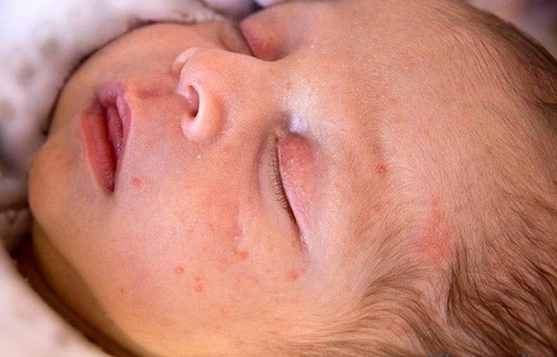Mụn sữa ở trẻ sơ sinh và cách điều trị 1