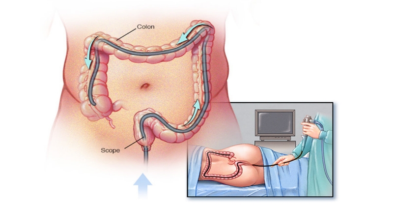 Tìm hiểu về hội chứng polyp hỗn hợp di truyền 3