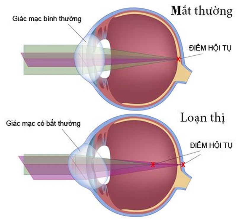 Loạn thị có di truyền không? 1