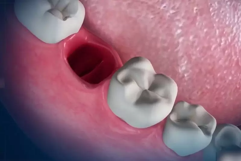 Còn chân răng có bị tiêu xương không? 1