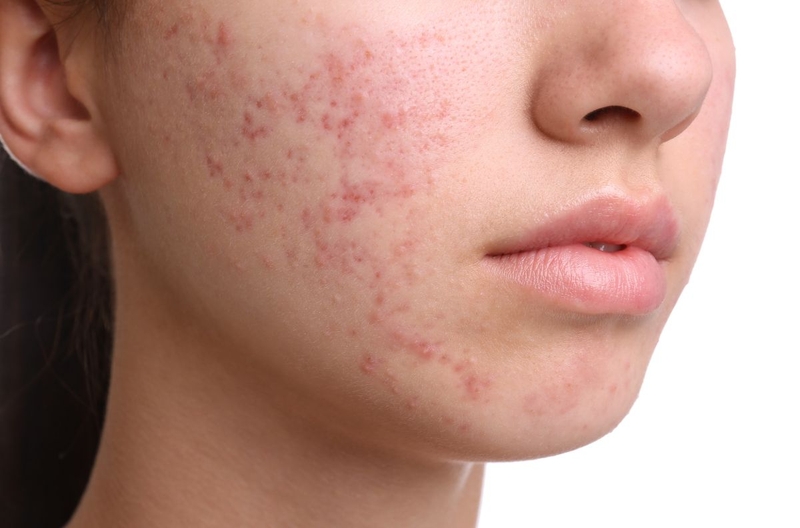 14 tuổi có nên dùng sữa rửa mặt? Kinh nghiệm chọn sữa rửa mặt phù hợp 1