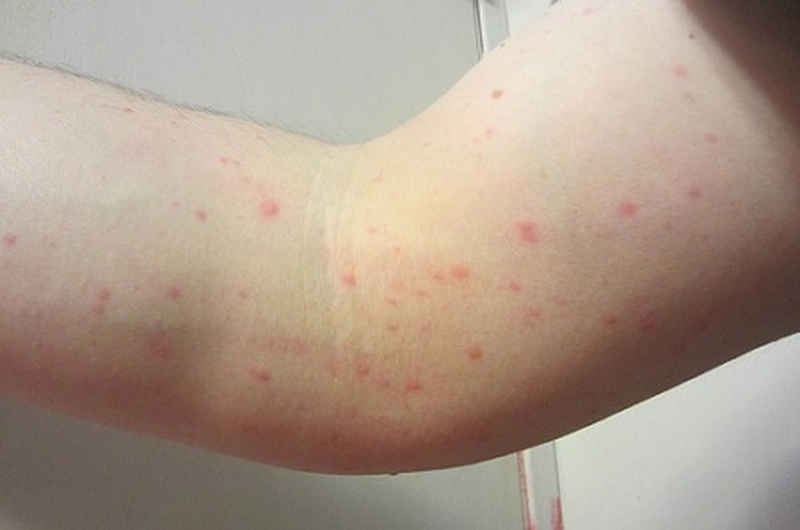 Mách bạn cách điều trị mề đay mẩn ngứa sau sinh 1