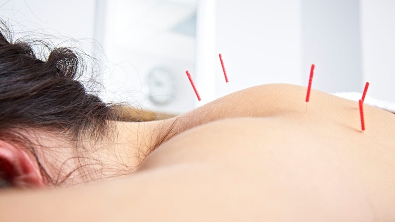 Châm cứu có đau không? Một số vấn đề có thể gặp phải khi châm cứu 3