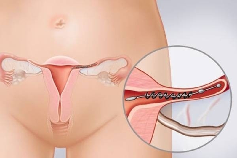 Thắt ống dẫn trứng có tháo được hay không? 3