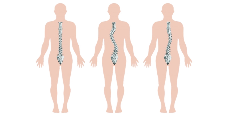 Những thói quen xấu dẫn đến vẹo cột sống 1