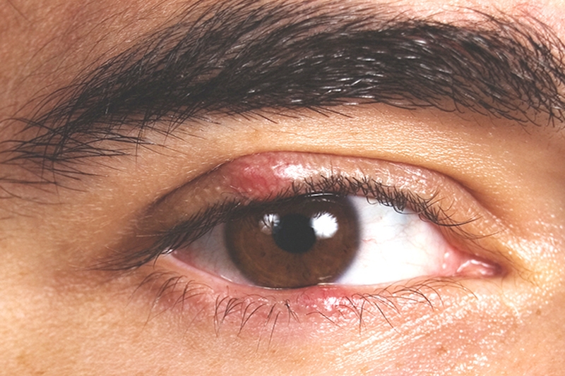 Bí quyết chữa lẹo mắt ở phụ nữ đang cho con bú 1