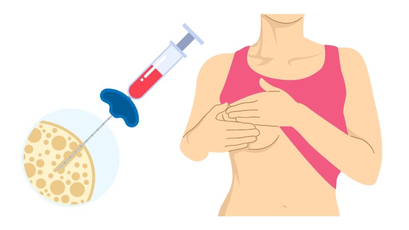 Sự thật về u xơ vú lành tính: nguyên nhân hình thành và cách phòng ngừa 3