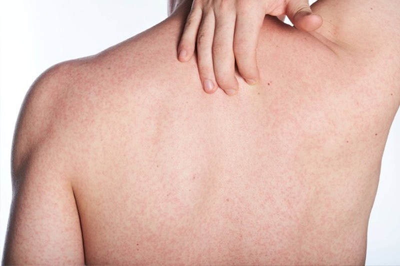 Dị ứng hải sản ngứa - Nguyên nhân và điều trị như thế nào? 2