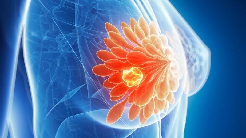Sự thật về u xơ vú lành tính: nguyên nhân hình thành và cách phòng ngừa 2