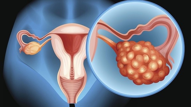 Lạc nội mạc buồng trứng là gì? Nguyên nhân, triệu chứng và cách điều trị?+1