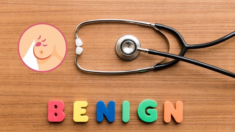 Sự thật về u xơ vú lành tính: nguyên nhân hình thành và cách phòng ngừa 1