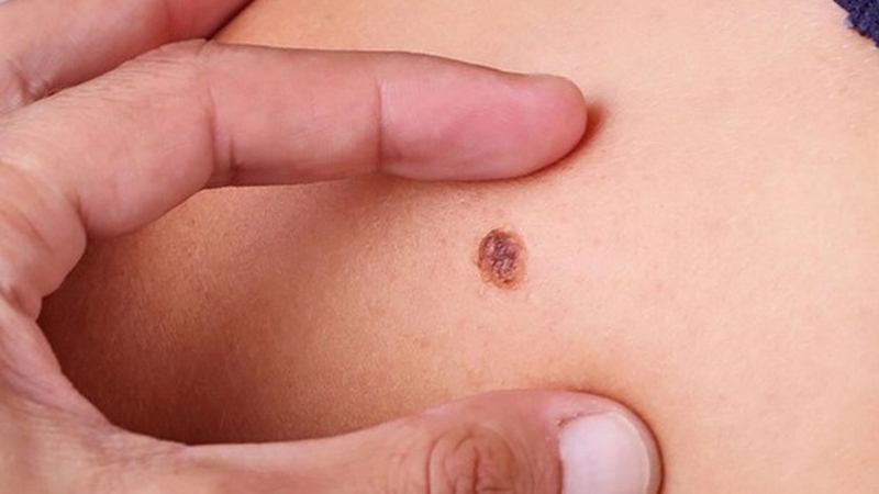 cac-giai-doan-ung-thu-da-cach-luu-y-va-danh-gia-ung-thu-da 1