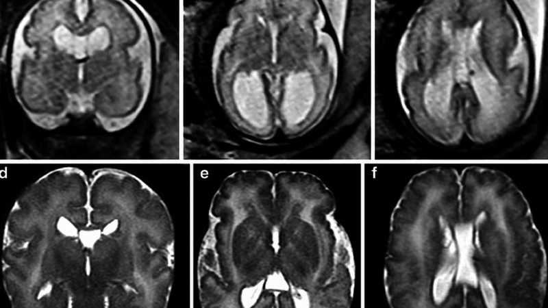 Hội chứng Zellweger là gì? Nguyên nhân và cách phòng tránh + 1