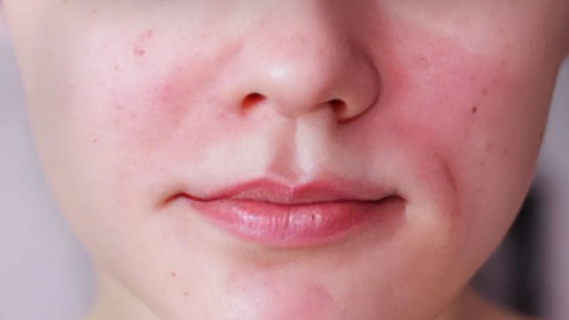 1 Lần Peel Da Bao Nhiêu Tiền? Peel Da Cần Lưu Ý Những Gì? 3