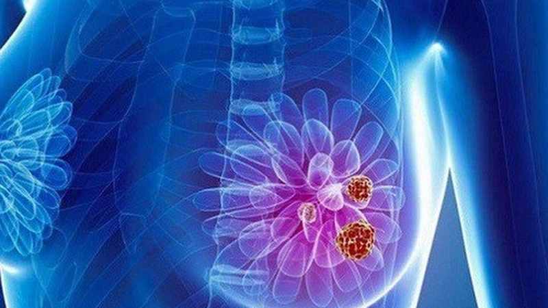 Những loại thuốc điều trị ung thư vú thường được sử dụng 1