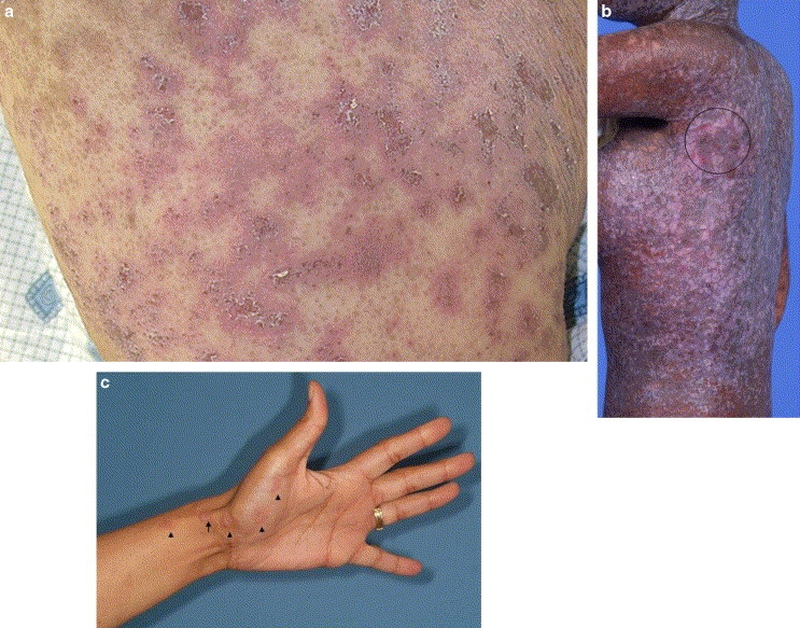 Tìm hiểu chung về bệnh ghép chống chủ do truyền máu2