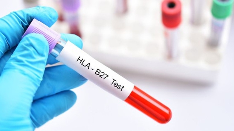 Xét nghiệm HLA B27 là gì? Tại sao cần làm xét nghiệm HLA B27?+1