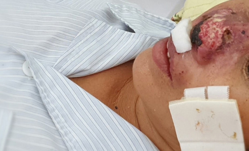 benh-whitmore-lay-qua-duong-nao-1