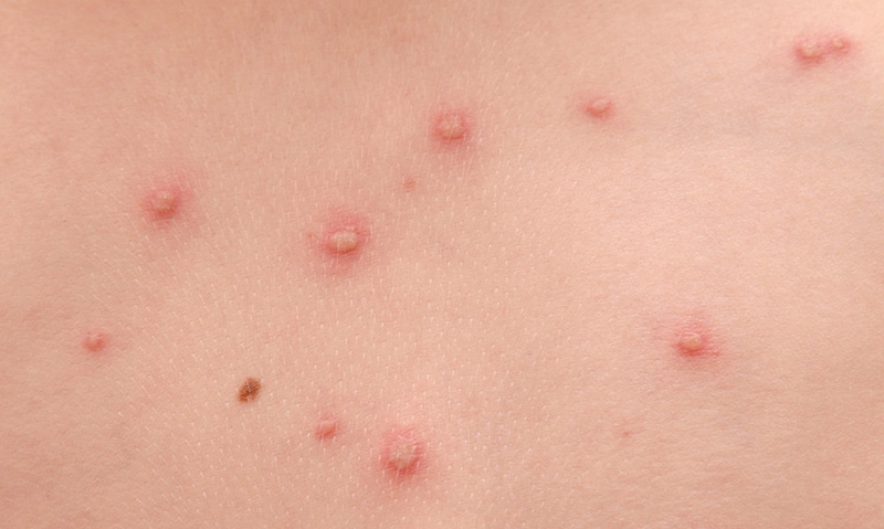 bi-kien-can-sung-mu-co-nguy-hiem-khong-1