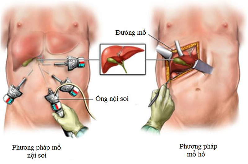 Phẫu thuật sỏi túi mật - giải pháp tối ưu điều trị bệnh triệt để  2