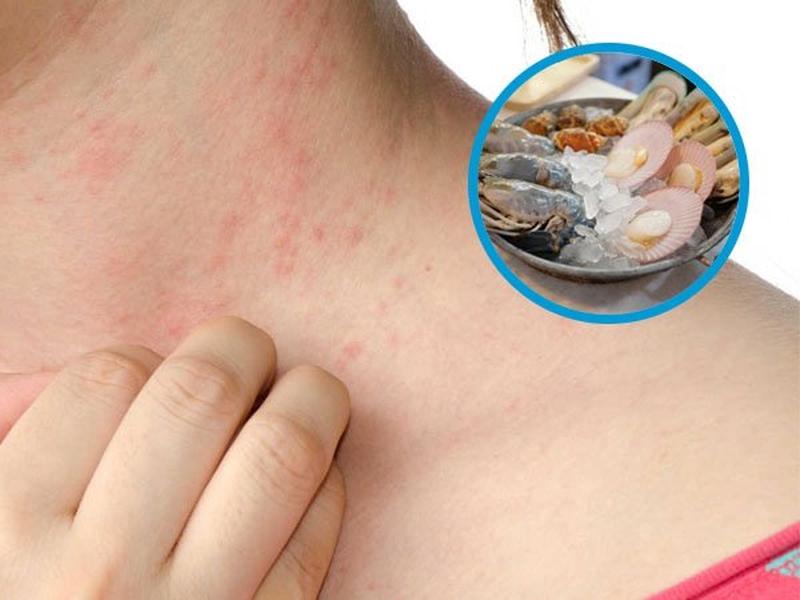 Giải đáp thắc mắc: Bị dị ứng hải sản uống gì giúp nhanh hồi phục? 2