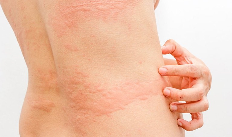 Phụ nữ bị nổi mề đay sau sinh bao lâu thì hết? 1