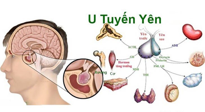 Đa u tuyến nội tiết týp 1 (MEN1)2
