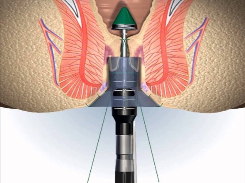 Quy trình khám trĩ ở bệnh viện Bình Dân 2
