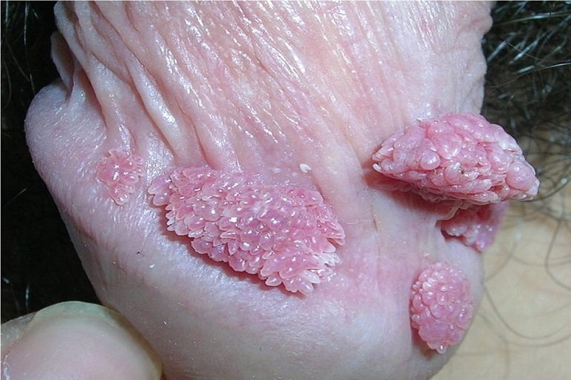 Mụn thịt xuất hiện trong bệnh sùi mào gà