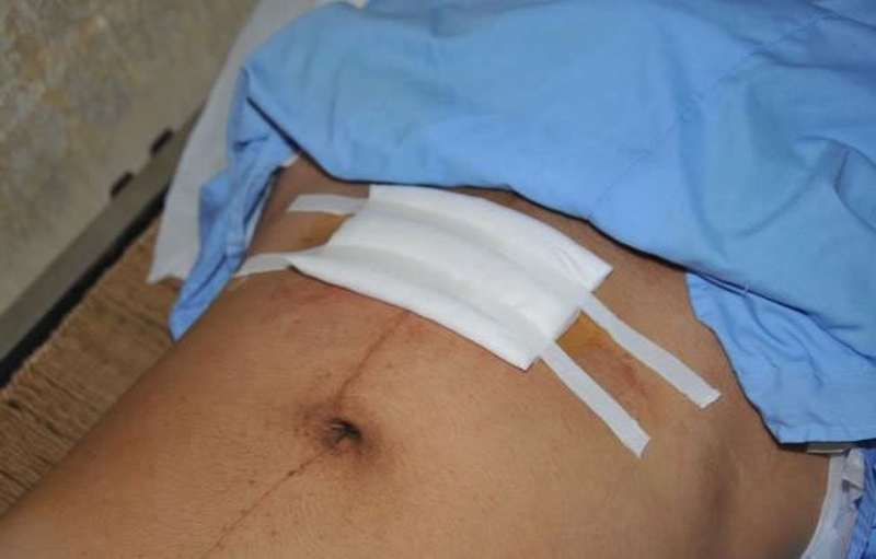 Nhiễm trùng vết mổ: Cần được nhận biết sớm để xử lý kịp thời 1