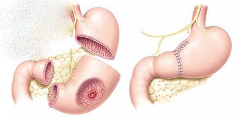 Sinh hoạt thường ngày sau mổ cắt dạ dày3