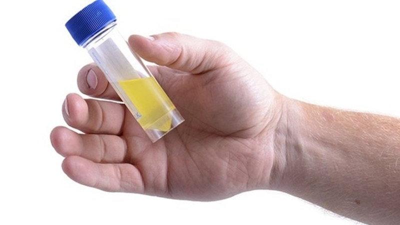 Nước tiểu đục là dấu hiệu của bệnh lý nào