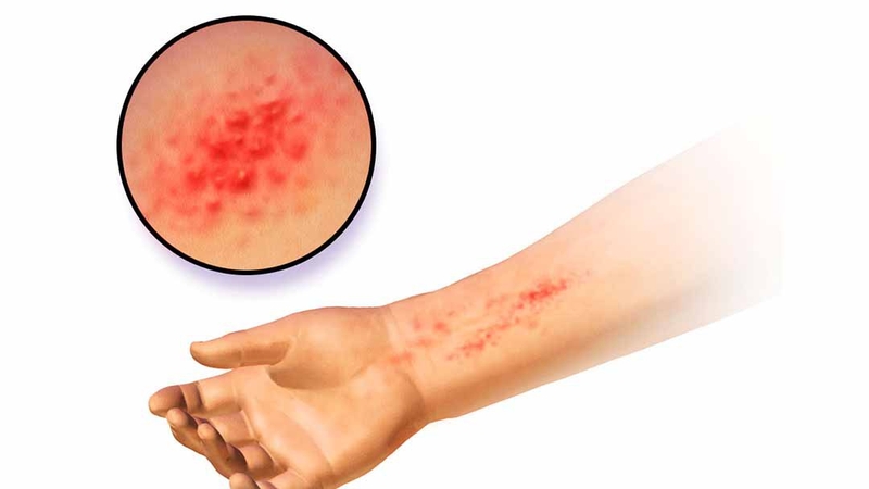 Nguyên nhân gây dị ứng dây da đồng hồ và gợi ý cách giải quyết 1