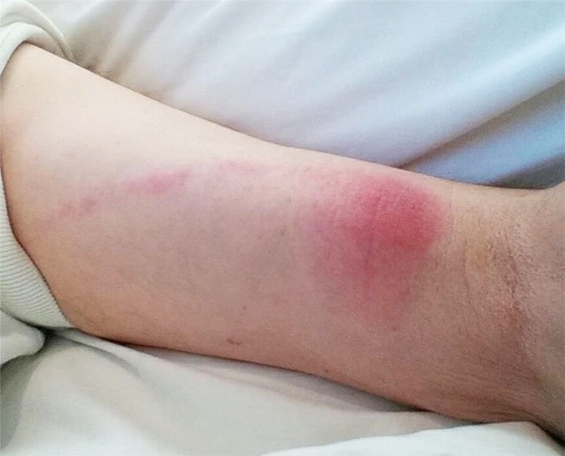 Viêm mô tế bào là bệnh gì? 1