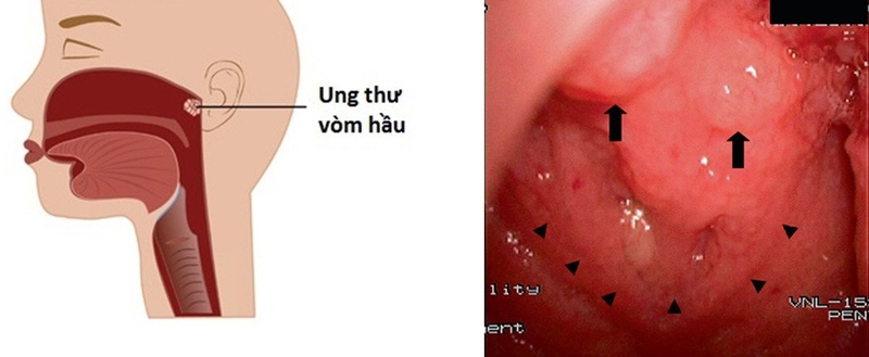 Ung thư mũi hầu di căn: Ảnh hưởng về thể chất, cảm xúc và xã hội1