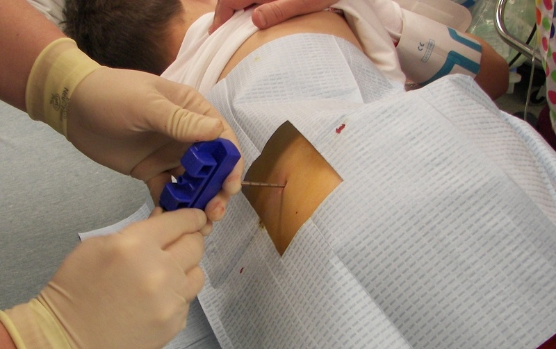 Chọc hút tủy xương hoặc sinh thiết tủy xương dưới gây mê2