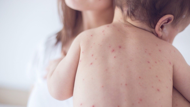 phat-ban-sau-sot-xuat-huyet-co-duoc-tam-khong-loi-khuyen-tu-bac-si 4