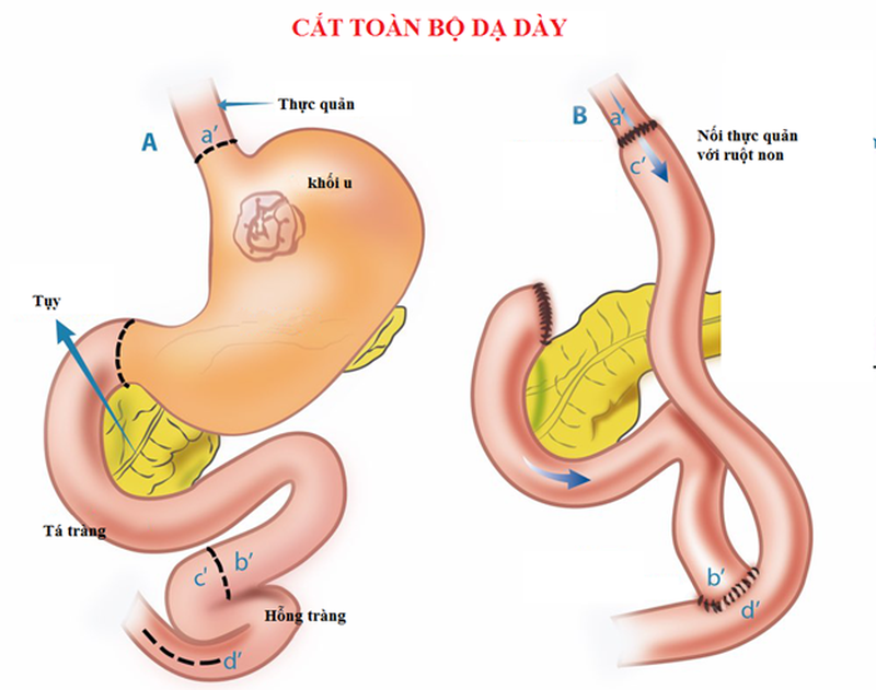 Sinh hoạt thường ngày sau mổ cắt dạ dày2