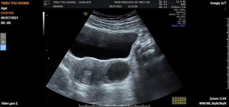 Thắc mắc: Vì sao cần uống nhiều nước và nhịn tiểu khi siêu âm bụng tổng quát? 5