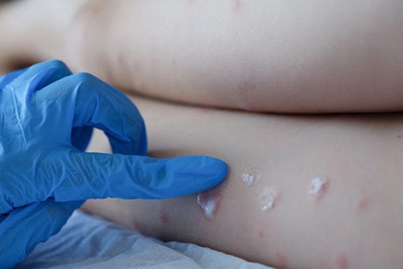 Triệu chứng và cách phòng bệnh đậu mùa khỉ4