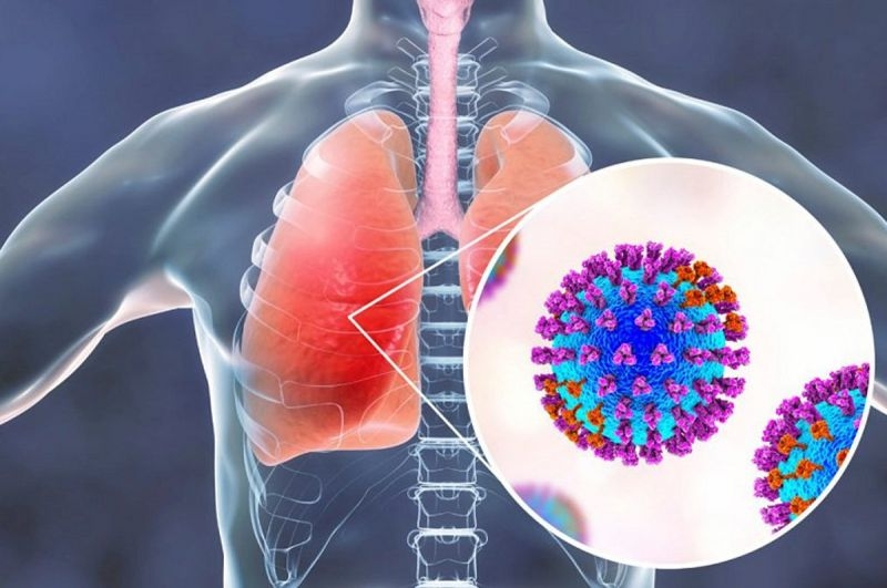 Những điều bạn cần biết về xơ phổi sau Covid 3